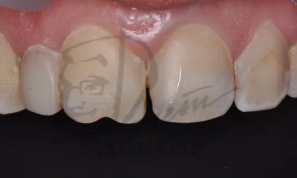Реставрация передних зубов ДО